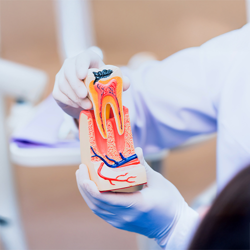 Root Canal Treatment 2