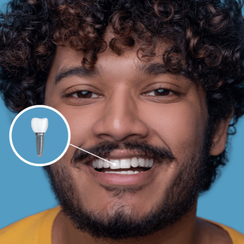 dental implant