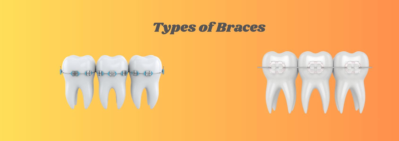 braces treatment