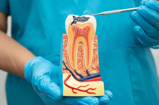 root canal treatment