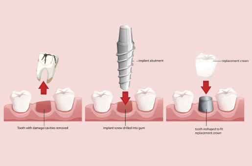 dental implant procedure