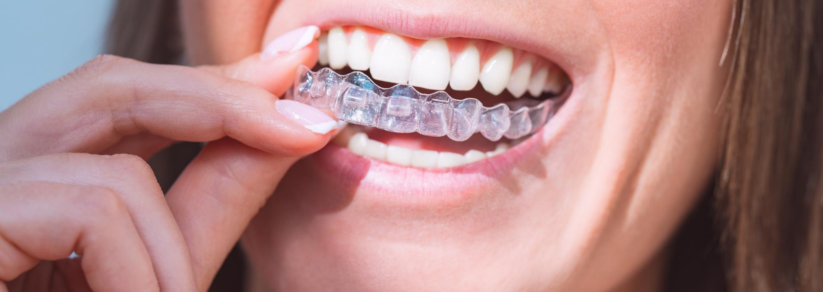 Invisalign