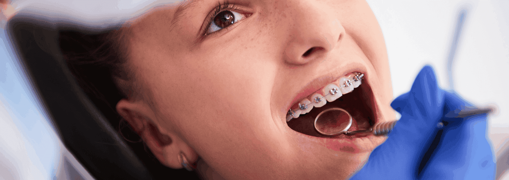 Braces treatment