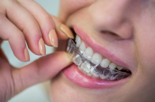 Invisalign treatment