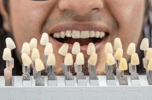Smile Makeover