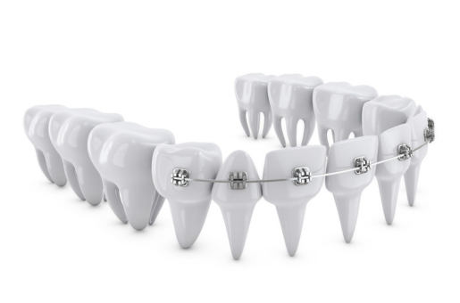 Damon Braces Treatment