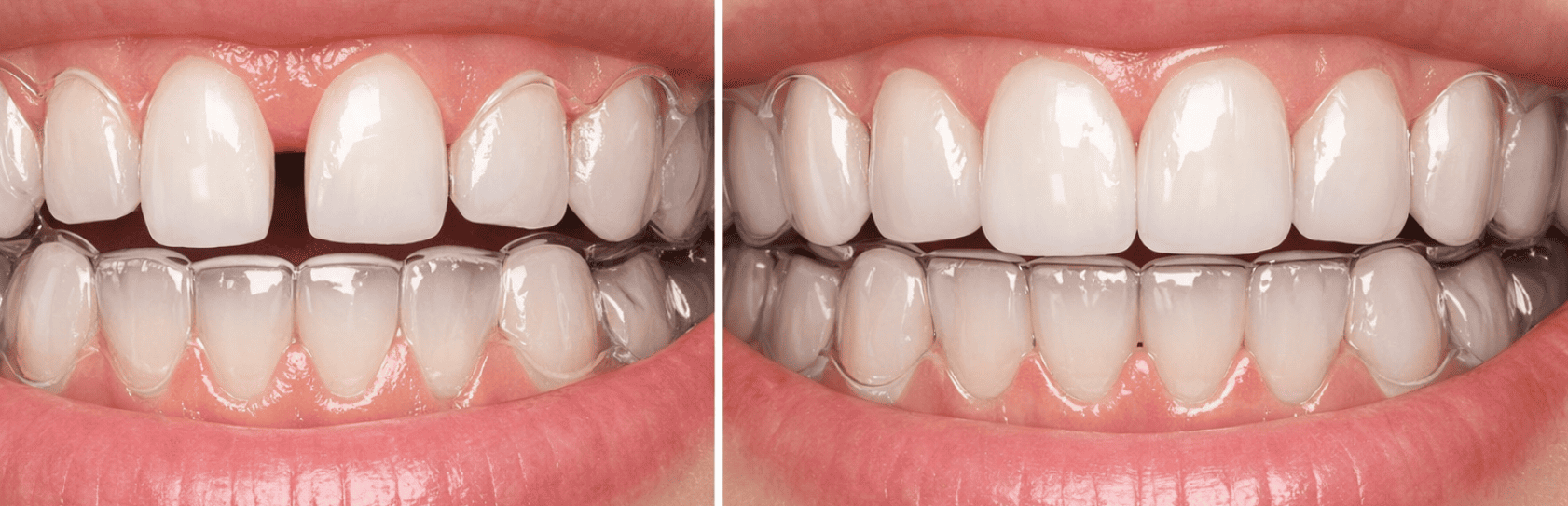 Invisalign Treatment