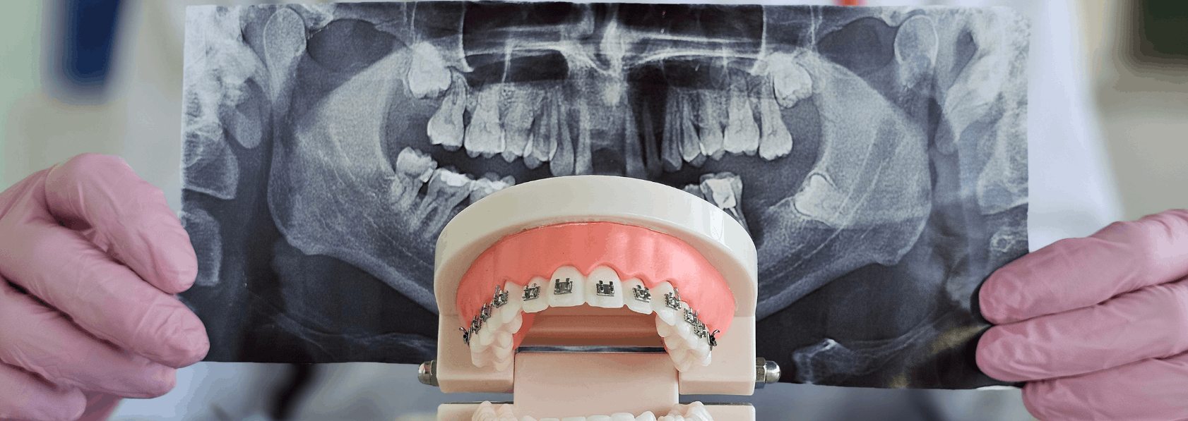 Damon Braces Treatment