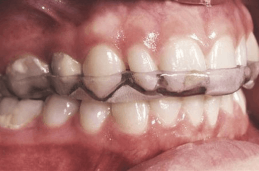 teeth grinding treatment