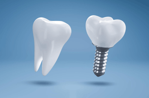 Dental Implant Treatment
