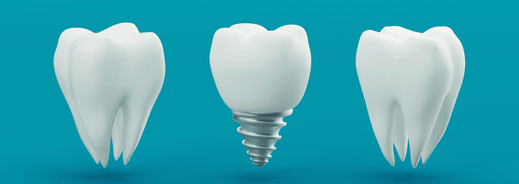 Dental Implant Treatment