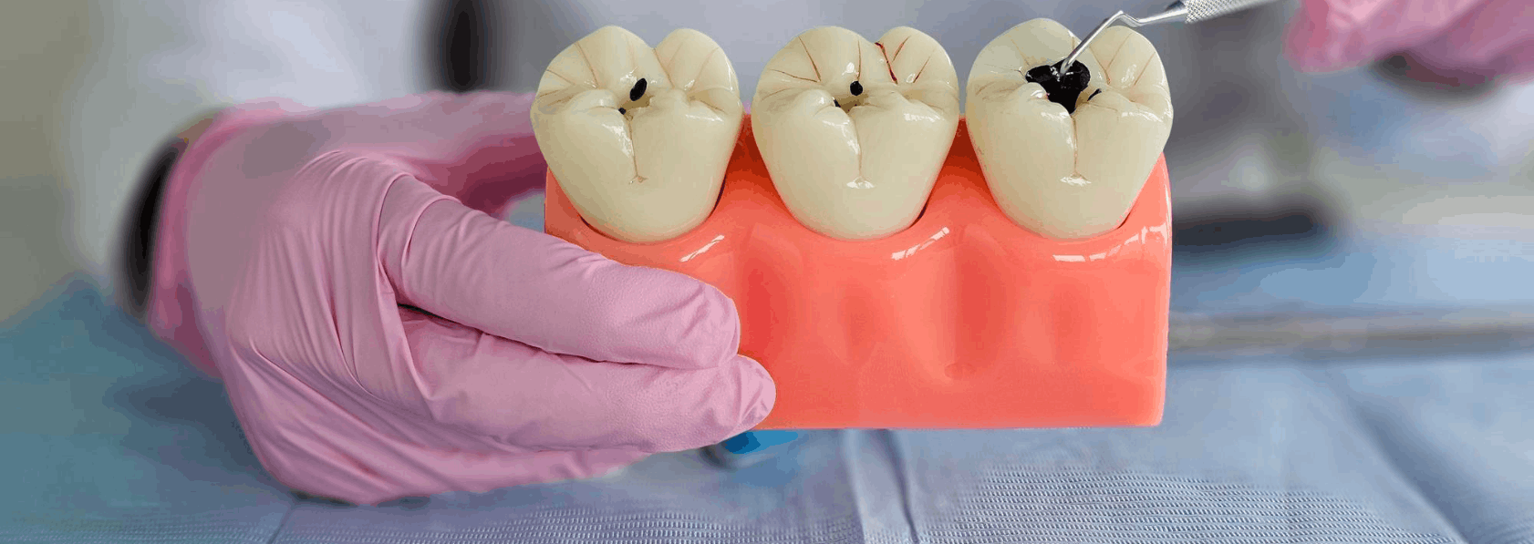 Root Canal Treatment